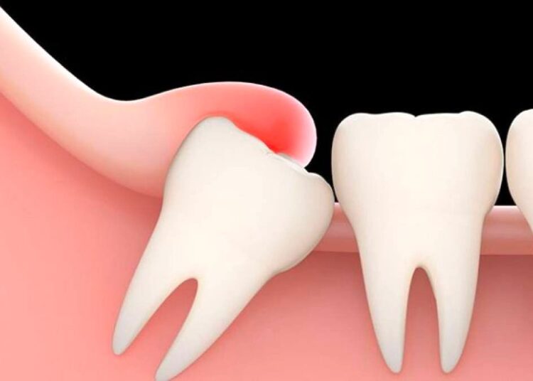 Чем опасно удаление рудиментов – зубов мудрости