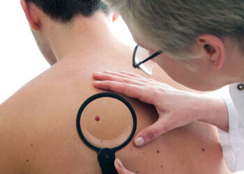 Дерматолог объяснила, возможен ли рак от повреждения родинки