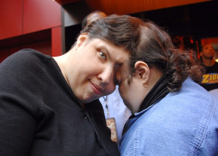 Сиамская близняшка рассказала об интимных моментах с мужчинами