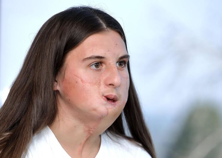 Как живет 16-летняя девушка, которой тигр в детстве растерзал все лицо